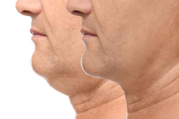 HIFU - Breakthrough in Anti - ageing 2 hifu results Walton on the Hill