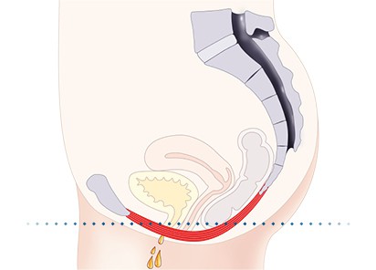 Pelvic-Floor Muscle Repair 5 Pelvic floor muscles Walton on the Hill