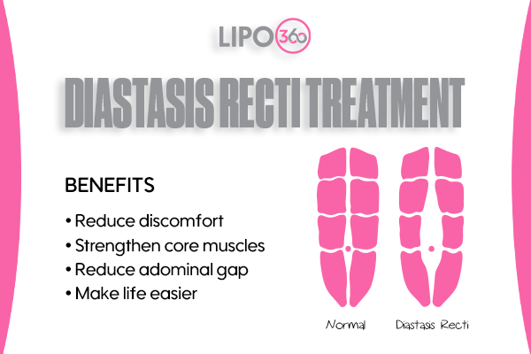 Revolutionising Muscle Repair: The Power of LIPO360 Body Sculpt Post-Injury 5 diastasis recti treatment Walton on the Hill