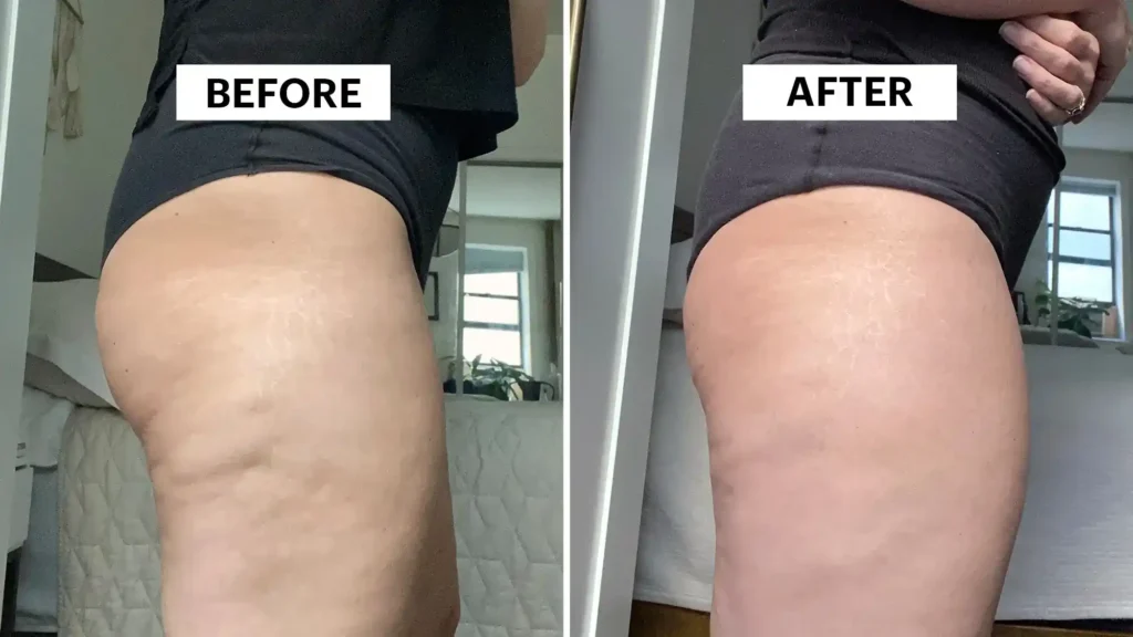 Sculpting Your Bum: Can Toning Exercises Really Reduce Cellulite? 1 Do Toning Exercise Walton on the Hill Really Tackle Cellulite?