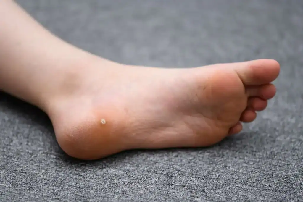 Cryotherapy For Warts And Also Verrucas 2 Image of verruca on the bottom of the foot that able to be treated with Cryotherapy Walton on the Hill