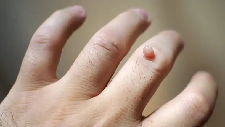 Cryotherapy For Warts And Also Verrucas 1 Image of blemish that Cryotherapy Walton on the Hill can remove with Lipo 360.