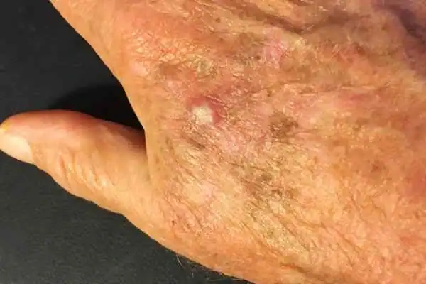 Cryopen For Actinic Keratoses 1 Image of Actinic keratoses Walton on the Hill on a person hand