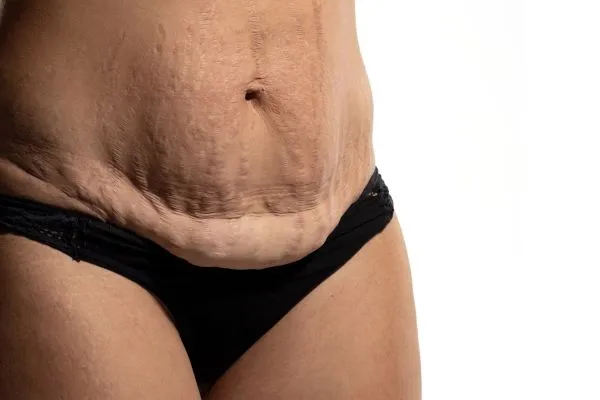 The Science of Skin Tightening 1 The science behind skin tightening Walton on the Hill picture of a woman's sagging skin on the stomach